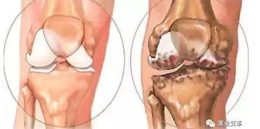 关节软骨再生领域最新进展报道速递