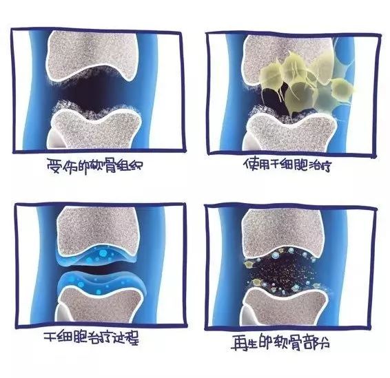 关节软骨再生领域最新进展报道速递