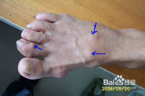 最新的治疗痛风,最新的治疗痛风,小巷深处的隐藏宝藏