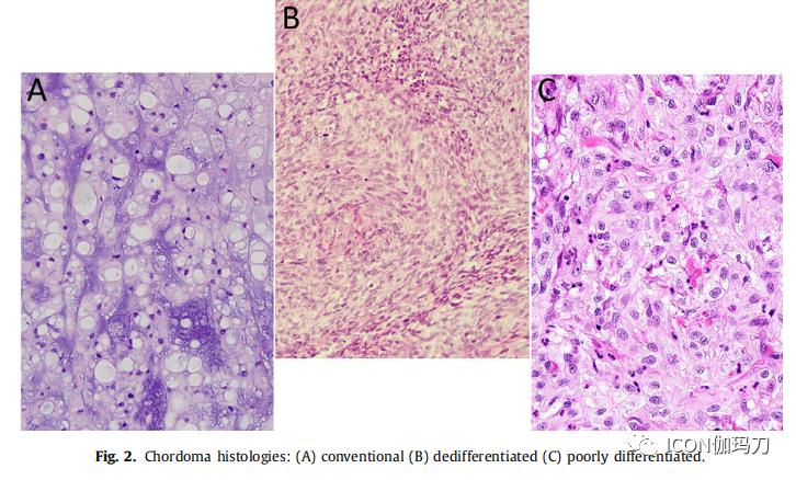 最新脊索瘤治疗,一场探索自然美景的治愈之旅