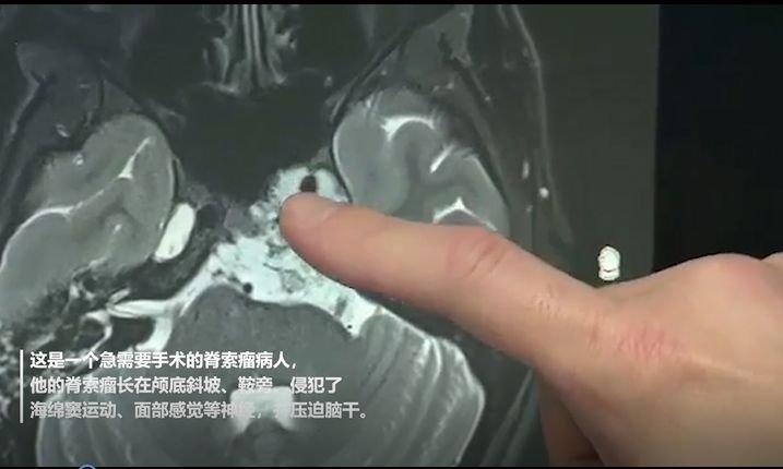 最新脊索瘤治疗,一场探索自然美景的治愈之旅