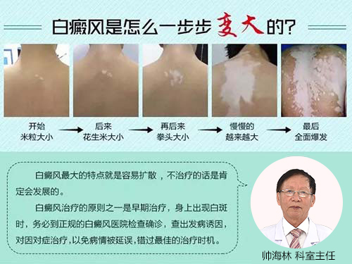 白癜风最新治疗,希望之光照亮康复之路