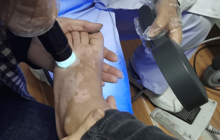 白癜风最新治疗,希望之光照亮康复之路