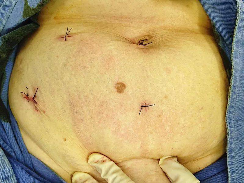 全国疝气最新治疗技术