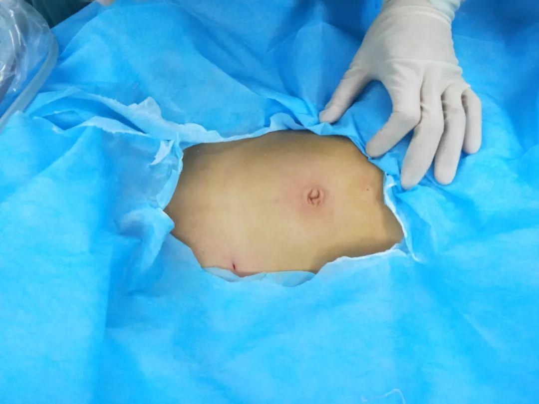 全国疝气最新治疗技术