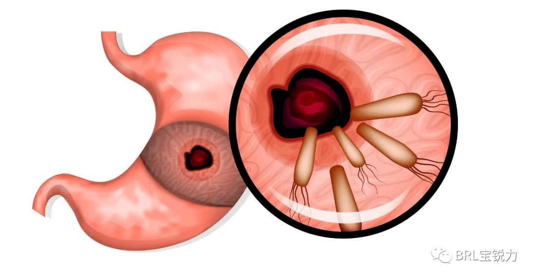 根除幽门螺旋杆菌2016最新方案论述