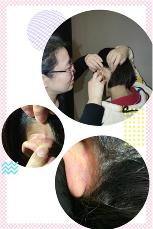 压疮护理新策略,提升患者舒适度与治疗效果的关键