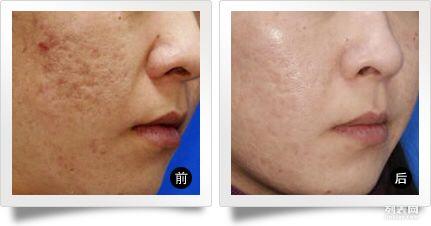 激光祛雀斑手术价格,深入解析与观点阐述