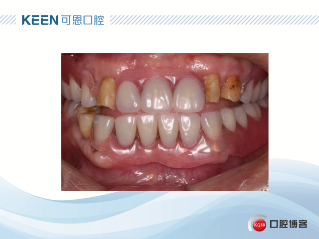 附着体义齿价格,深入解析与观点阐述