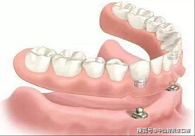附着体义齿价格,深入解析与观点阐述