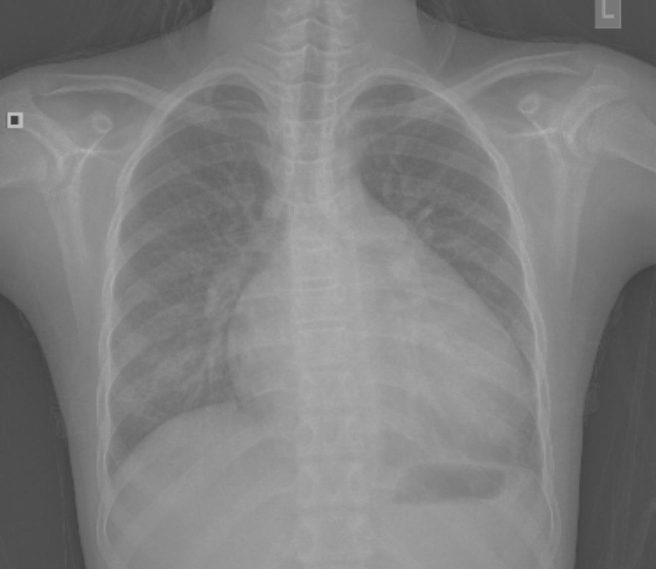 扩心病的最新治疗