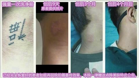 洗纹身的价格大概是多少