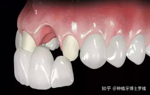 最新活动假牙,一口新牙,一个全新的人生